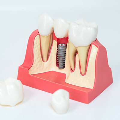 Service d’implantologie dentaire à Molenbeek | VOCLIdental