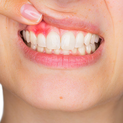 Parodontologie à Molenbeek | VOCLIdental